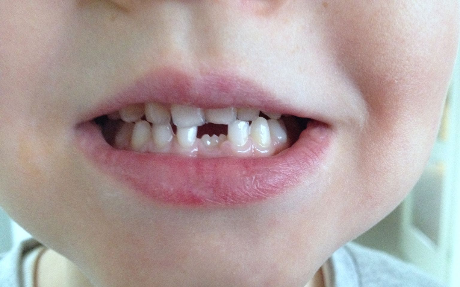 Tandsæt med ny fortand på vej