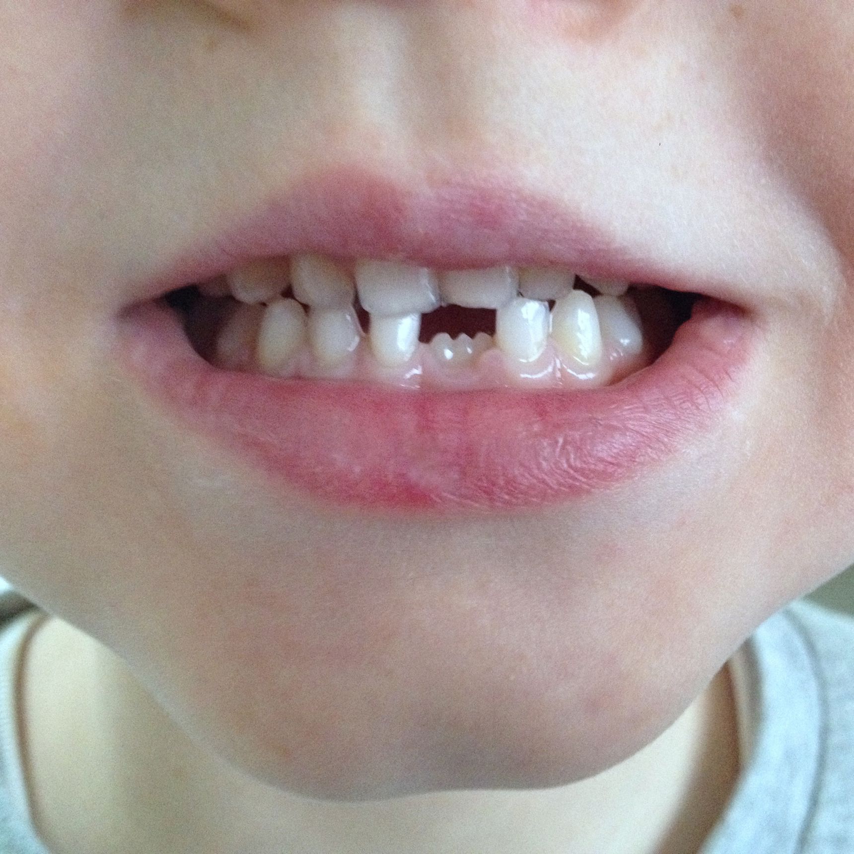 Tandsæt med ny fortand på vej